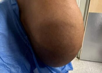 فريق طبي عراقي ينجح في استئصال غدة درقية بوزن 4 كيلوجرام 