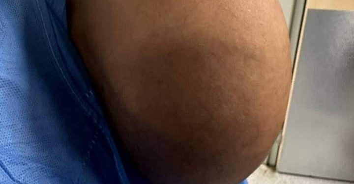 فريق طبي عراقي ينجح في استئصال غدة درقية بوزن 4 كيلوجرام