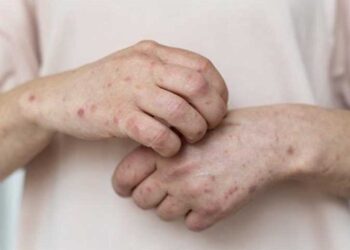 جدري القردة