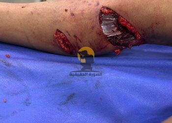 القصة الكاملة لاعتداء كلب على أحد الأطفال في كمباوند شهير.. شاهد عيان: ربنا قدرني أنقذ الولد.. لكن دي أسوأ حاجة شوفتها في حياتي.. ومحتاج أتعالج من اللي شوفته 