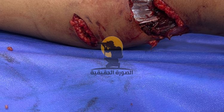 القصة الكاملة لاعتداء كلب على أحد الأطفال في كمباوند شهير.. شاهد عيان: ربنا قدرني أنقذ الولد.. لكن دي أسوأ حاجة شوفتها في حياتي.. ومحتاج أتعالج من اللي شوفته 