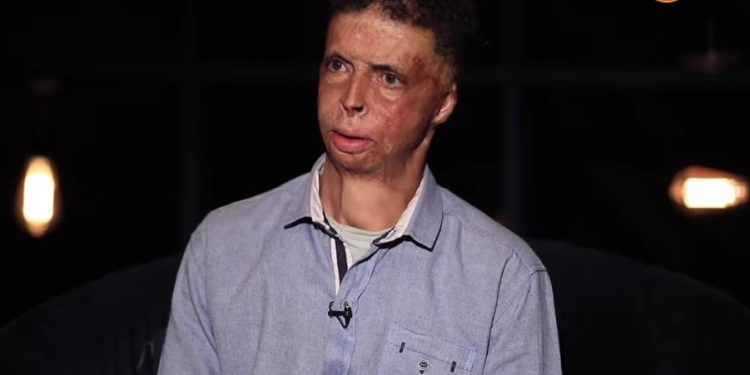 تعرض للحرق وأخفى نفسه عن الناس.. تعرف على قصة وائل عوكل؟