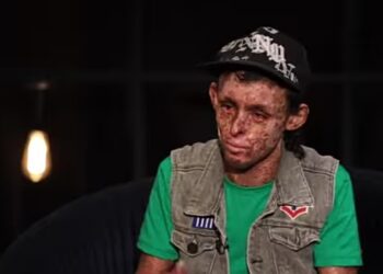 مبيقدرش يشوف الشمس وحلمه يغير نظرة المتنميرين.. “الطفل القمري” ما القصة؟