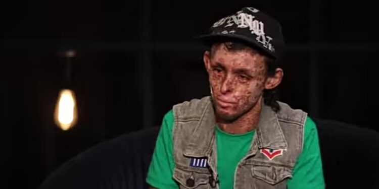 مبيقدرش يشوف الشمس وحلمه يغير نظرة المتنميرين.. “الطفل القمري” ما القصة؟