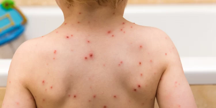 الصحة تنفي رصد أي حالات إصابة بـ الجدري المائي أعراضها بغير المعتاد